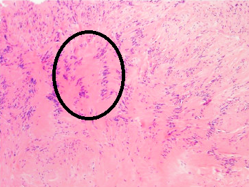 Schwannoma