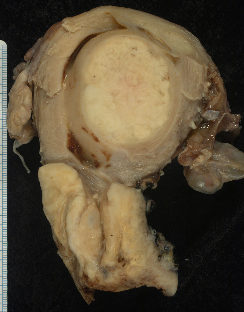 Cervical Carcinoma