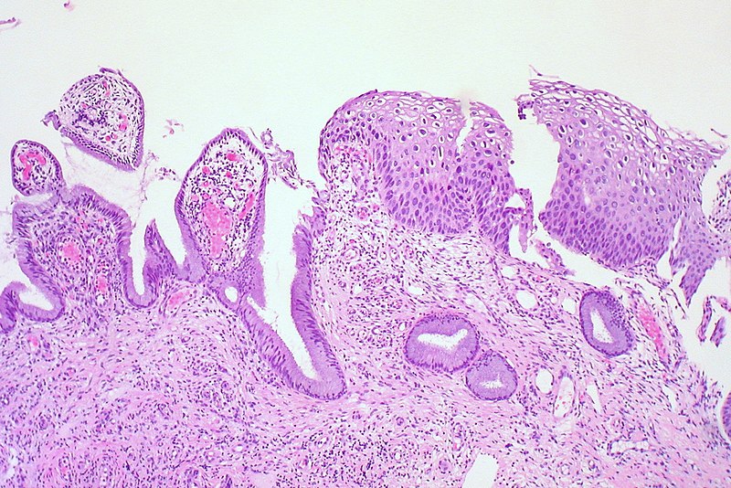 Cervical Intraepithelial Neoplasia