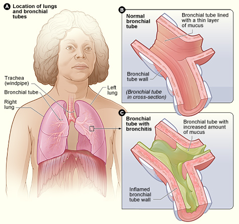 Chronic Bronchitis