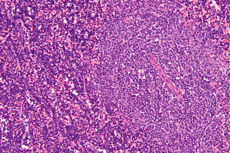 Chronic Lymphocytic Leukemia