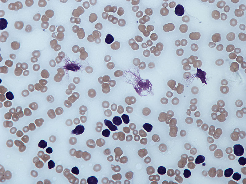 Chronic Lymphocytic Leukemia