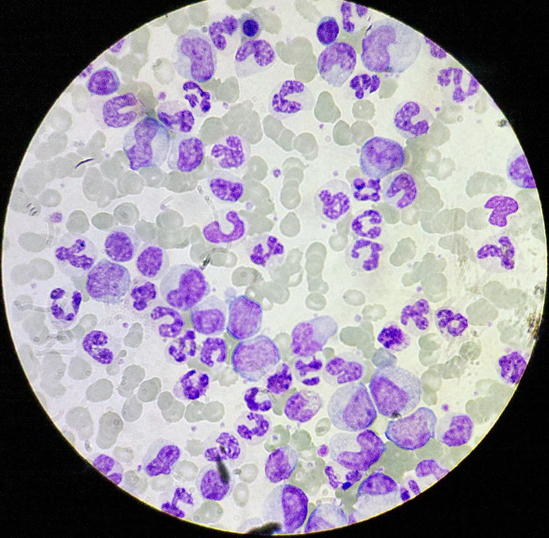 Chronic Myeloid Leukemia