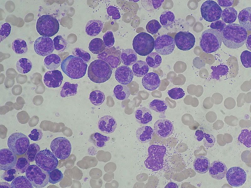 Chronic Myeloid Leukemia