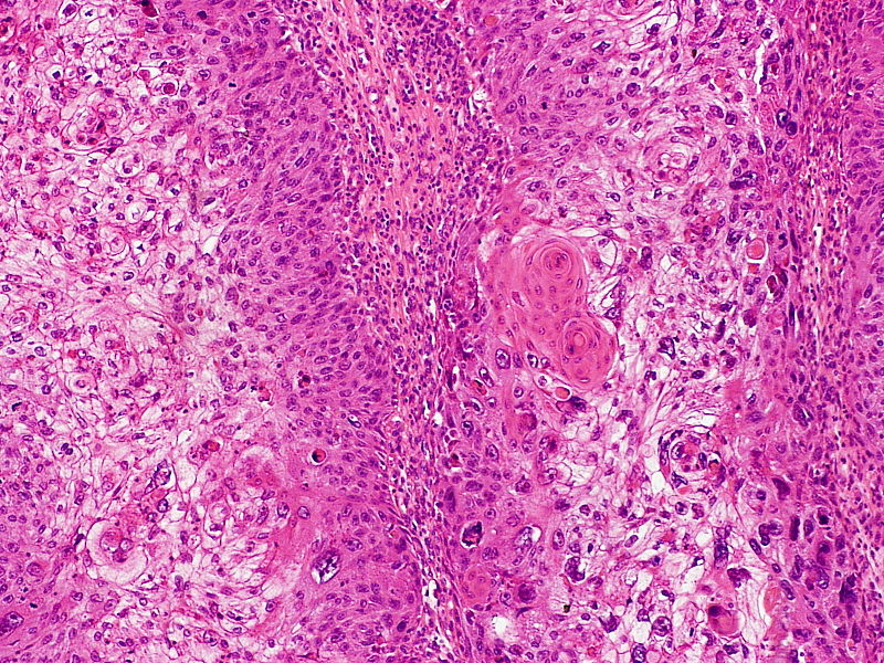 Clear Cell Adenocarcinoma
