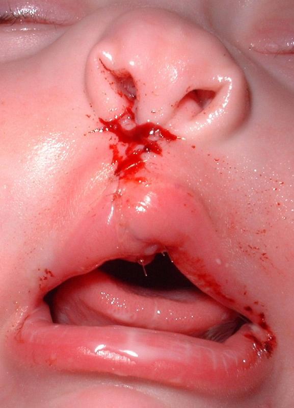 Cleft Lip