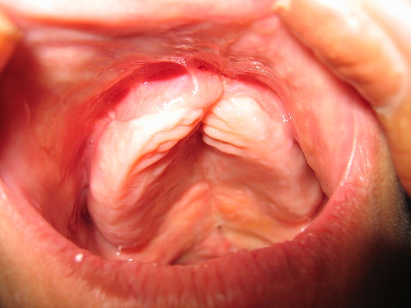 Cleft Palate
