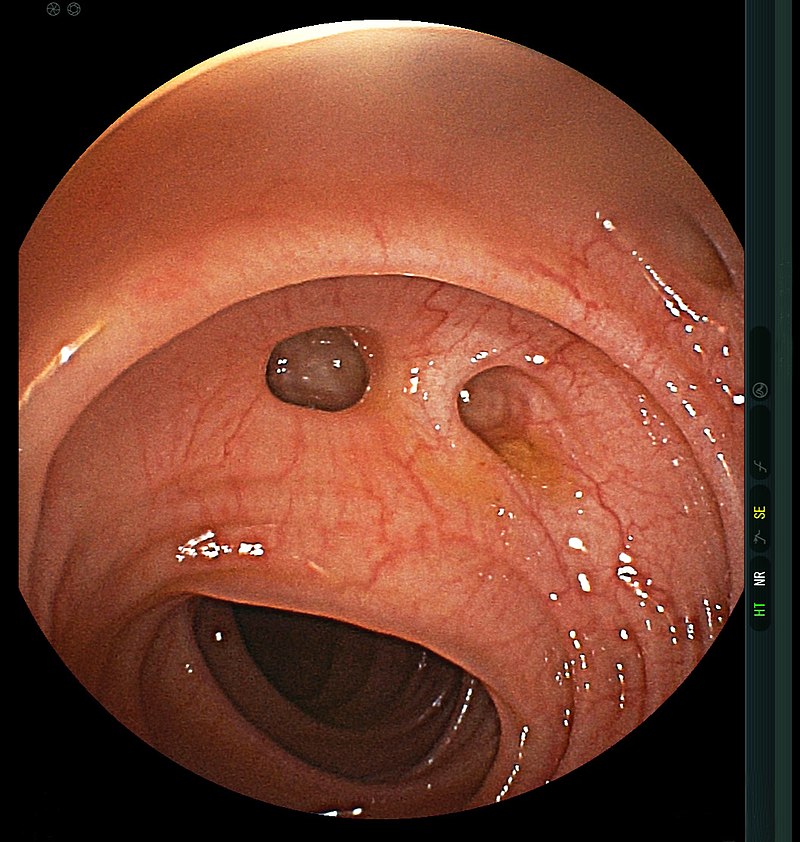 Colonic Diverticula