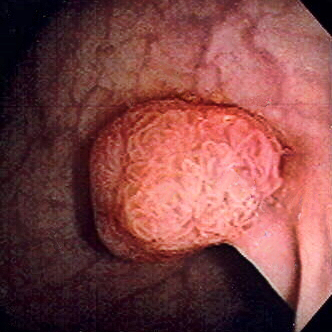 Colonic Polyps
