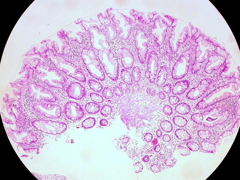 Colonic Polyps