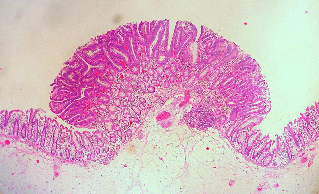 Colonic Polyps
