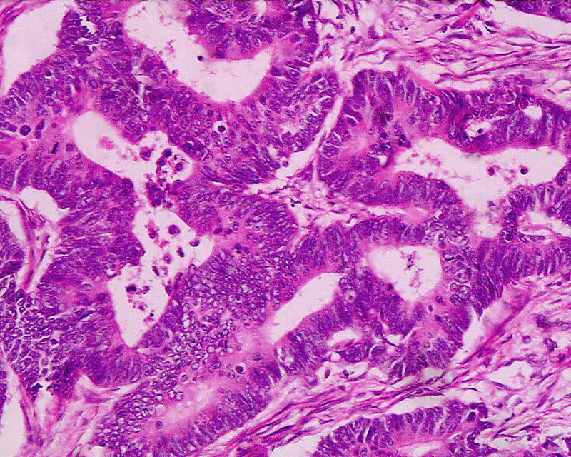 Colonic Polyps