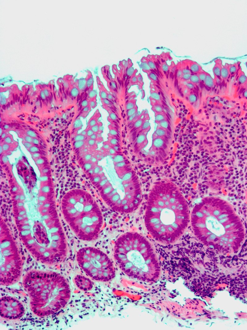 Colonic Polyps