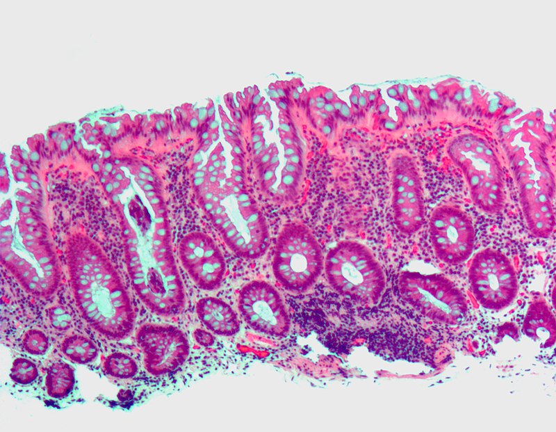 Colonic Polyps