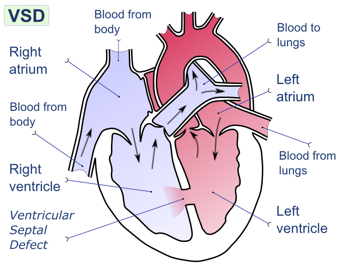 Ventricular Septal Defect (VSD)