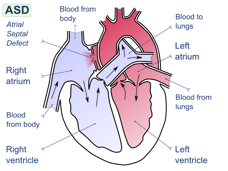 Atrial Septal Defect (ASD)