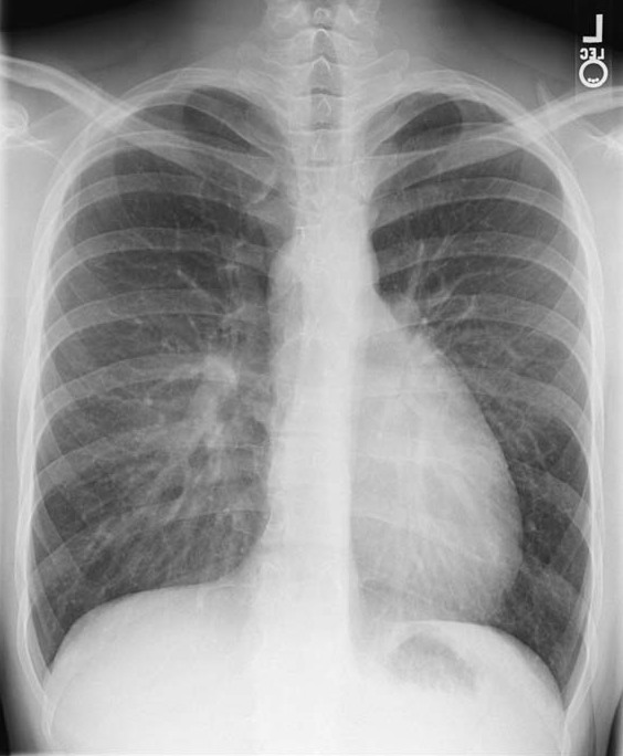 Transposition of the Great Vessels