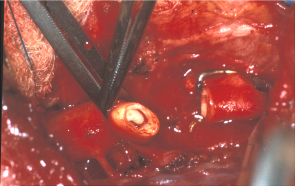 Congenital Heart Defects