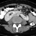 Congenital Horseshoe Kidney