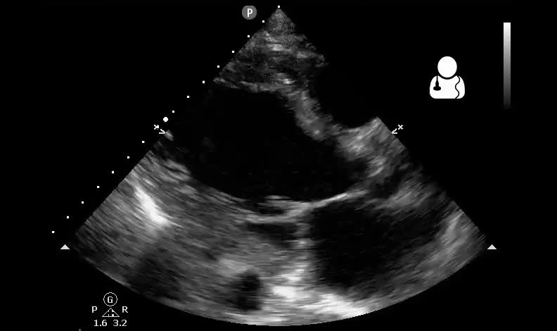 Congestive Heart Failure