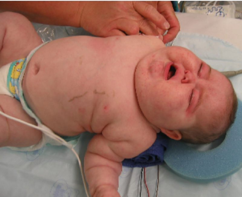 Cushing Syndrome (Hypercortisolism)