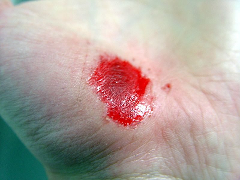 Cutaneous Wound Healing
