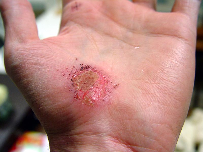 Cutaneous Wound Healing