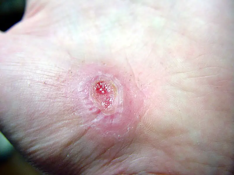 Cutaneous Wound Healing