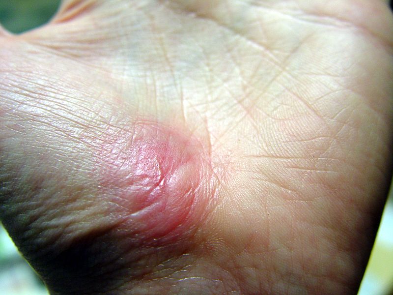 Cutaneous Wound Healing