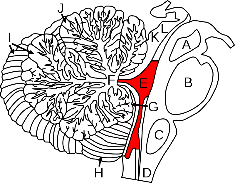 Dandy Walker Malformation