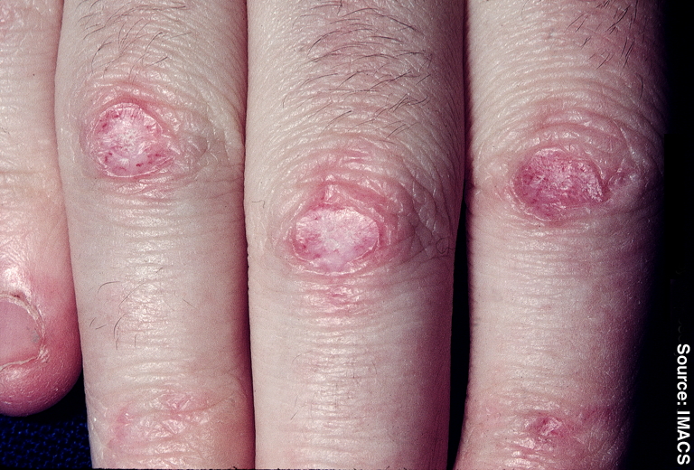 Dermatomyositis