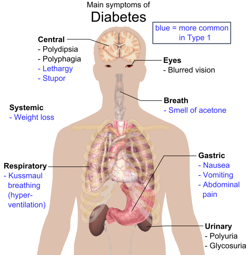 Diabetes Mellitus Type 1
