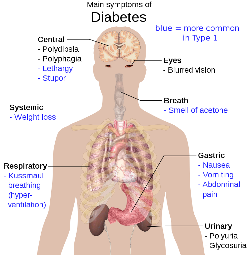Diabetes Mellitus Type 2