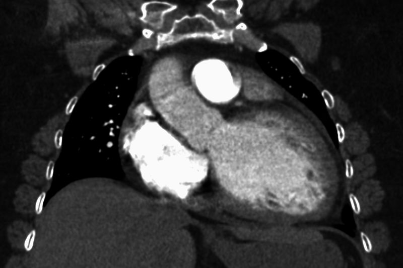 Dilated Cardiomyopathy