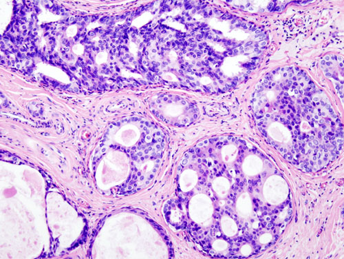 Ductal Carcinoma In Situ (DCIS)