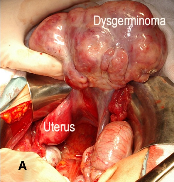Dysgerminoma