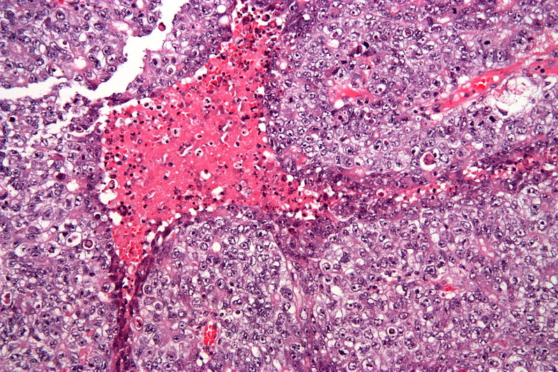 Embryonal Carcinoma