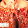 Endocarditis Pathology