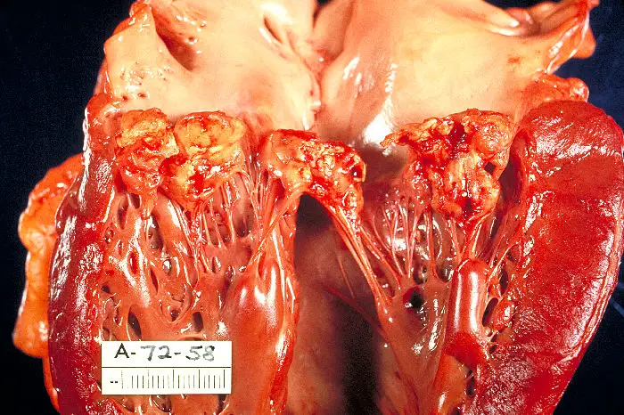 Endocarditis Pathology