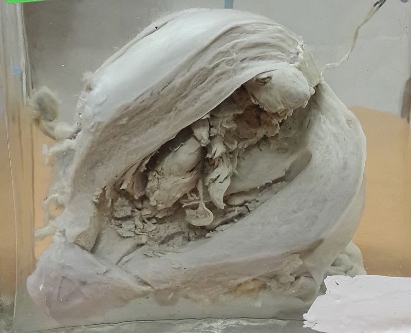 Endometrial Carcinoma