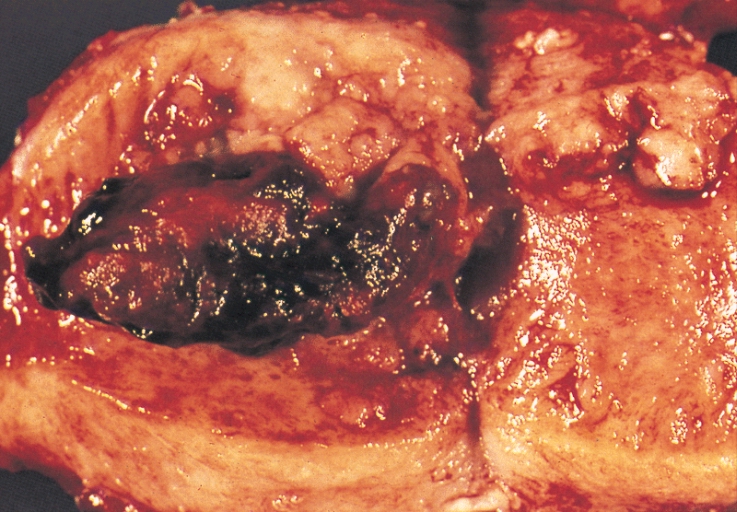 Endometrial Carcinoma