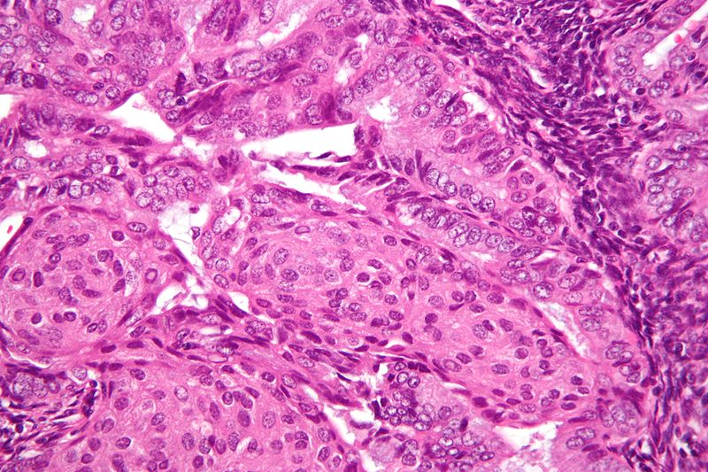 Endometrial Carcinoma