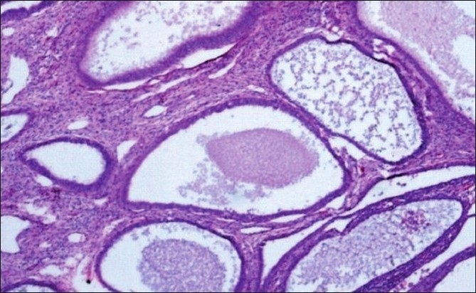 Endometrial Hyperplasia