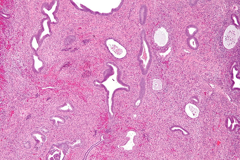 Endometrial Polyp