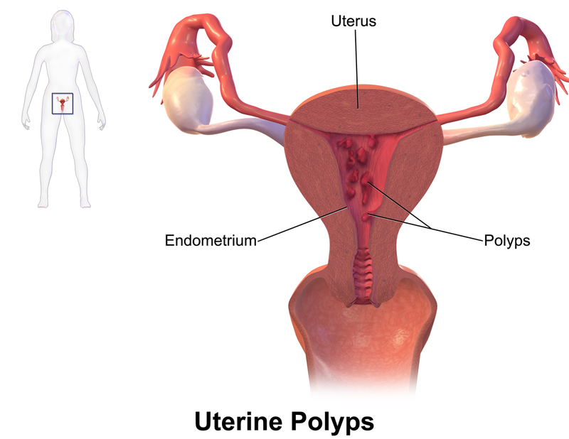 Endometrial Polyp