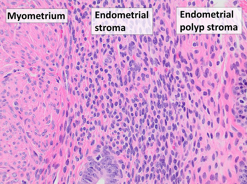 Endometrial Polyp