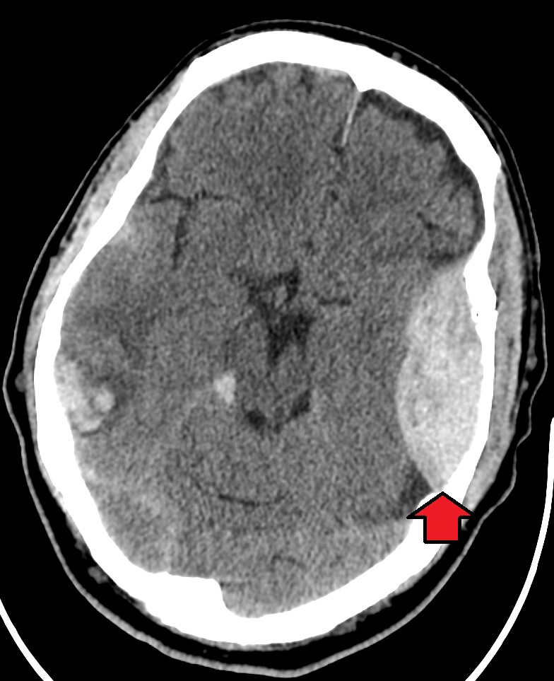 Epidural Hematoma