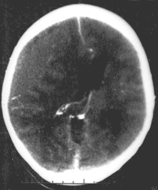 Epidural Hematoma