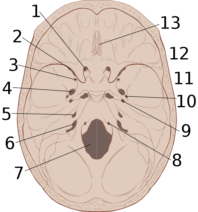 Inferior of the Skull Epidural Hematoma