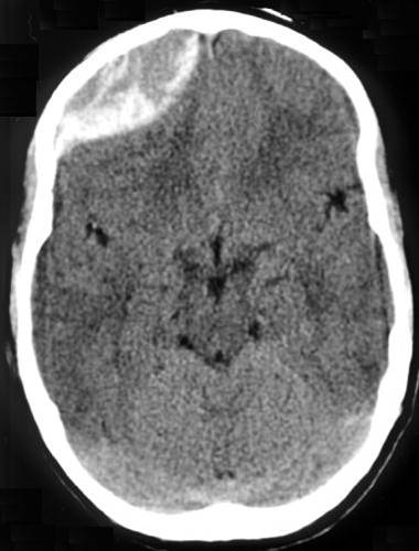 Epidural Hematoma